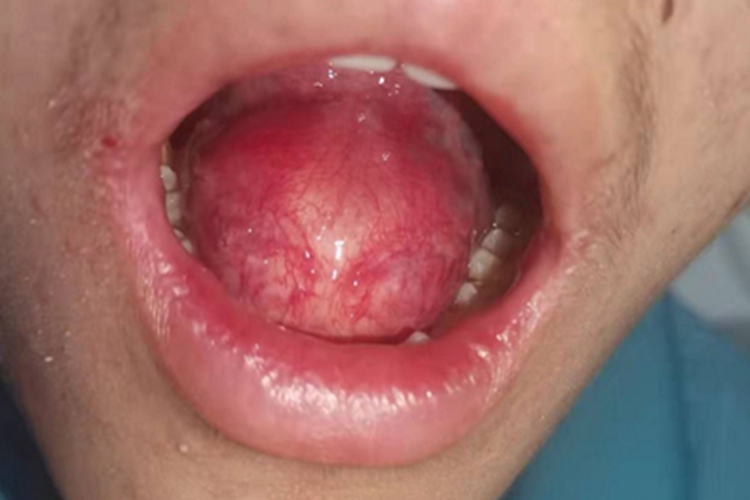 皮样囊肿口腔症状图 皮样囊肿口腔症状图