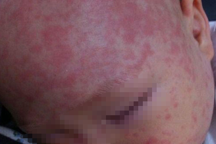 发烧后脸上起风疹图 发烧后脸上起风疹图