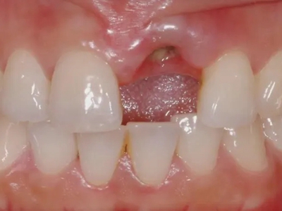 急性坏死性龈口炎门牙牙龈处有小疙瘩图.jpeg