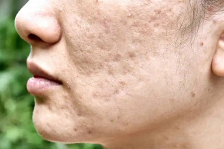 皮肤痘疮样斑状萎缩症状图