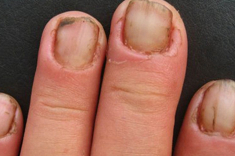 念珠菌性甲沟炎指甲症状图