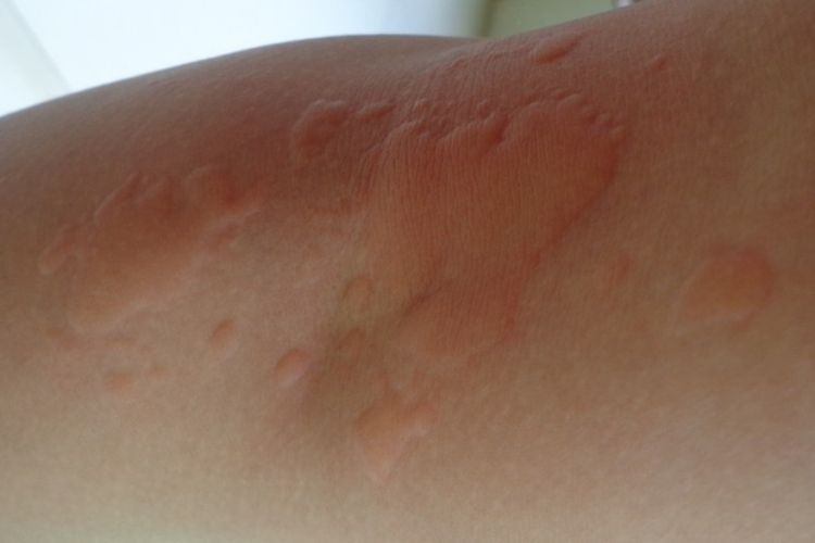 小孩急性自发性荨麻疹图 小孩急性自发性荨麻疹图