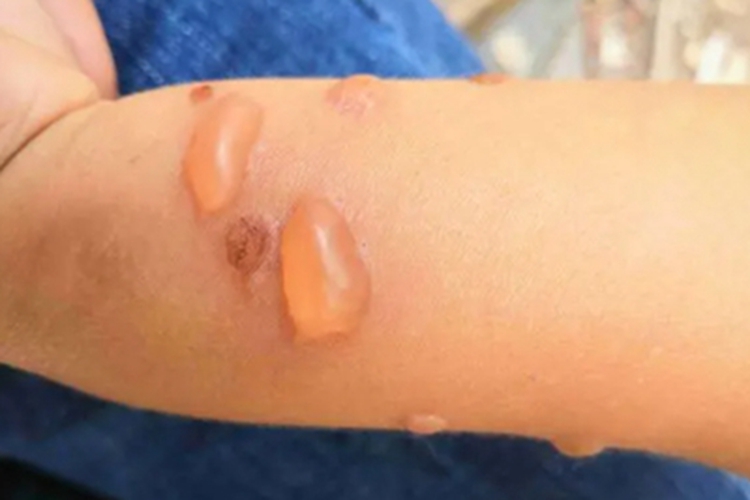 幼年型类天疱疮胳膊大水疱图