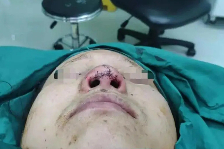 鼻骨骨折术后缝合图 鼻骨骨折术后缝合图