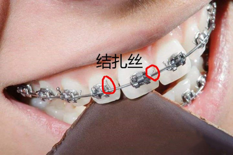 牙套结扎丝图 牙套结扎丝图