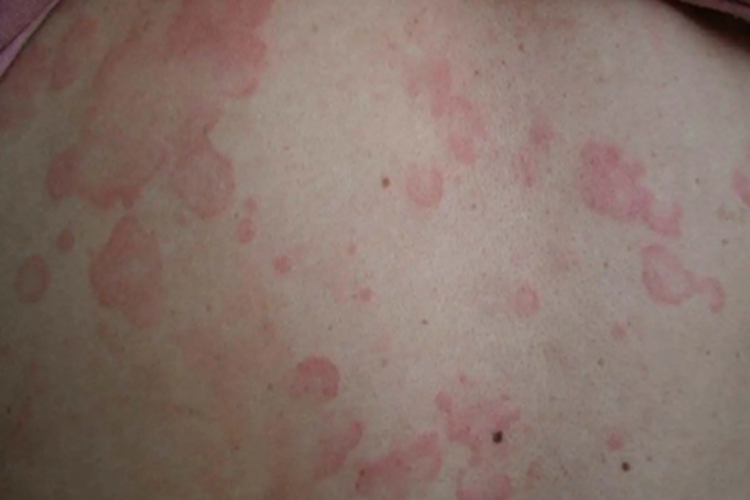 离心性环状红斑胸部红斑图 离心性环状红斑胸部红斑图