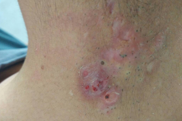 皮肤蝇蛆病匐行疹型图