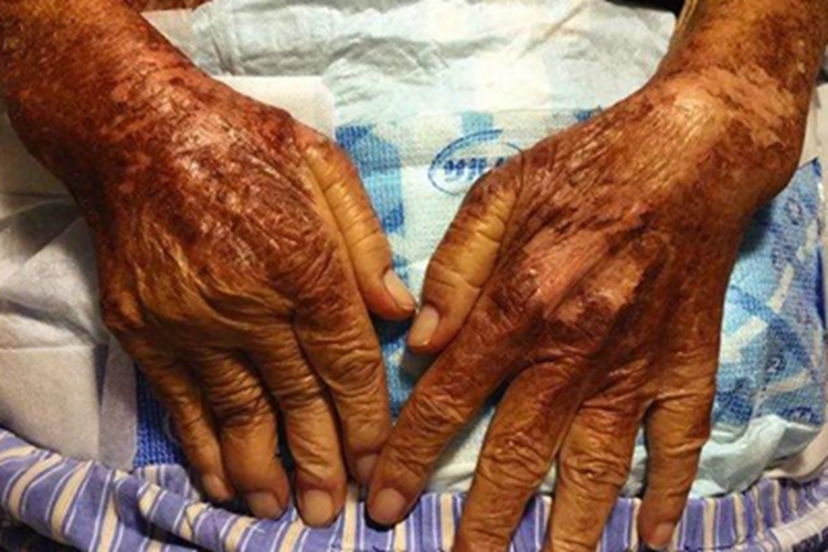 烟酸缺乏症手背症状图