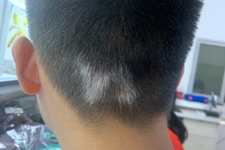 白癜风后脑勺症状图