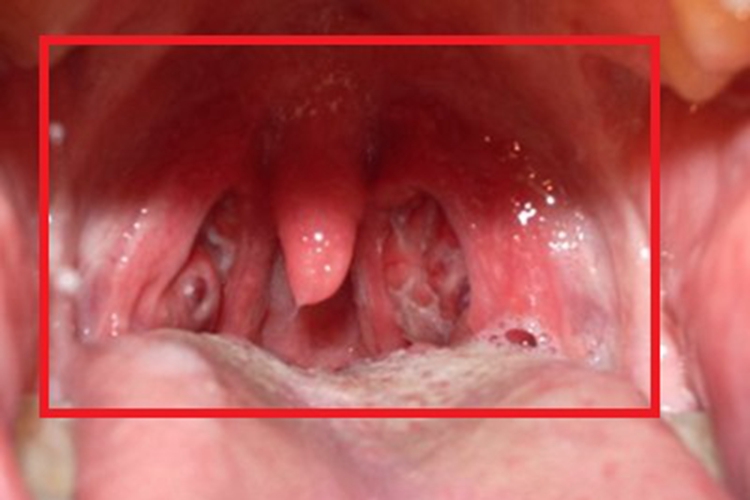慢性咽炎咽喉红肿图