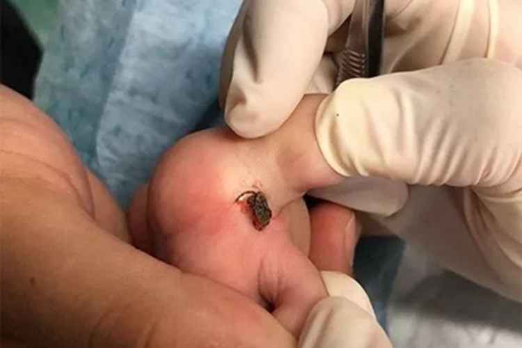 蜱咬伤脚趾缝里红肿图