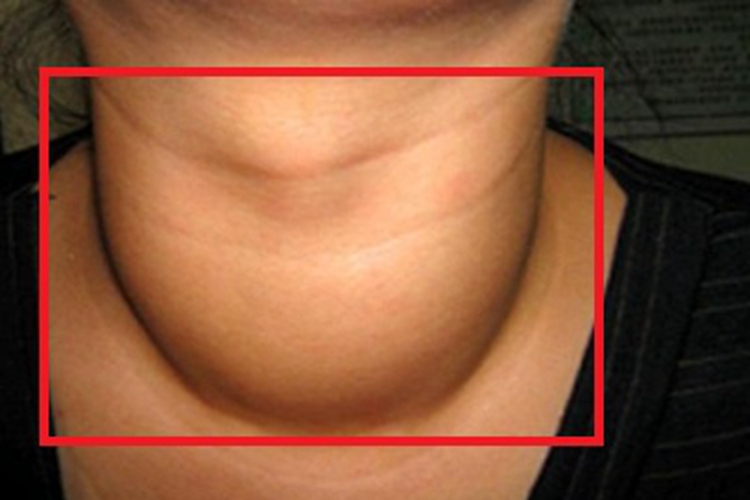 结节性甲状腺肿局部肿大图
