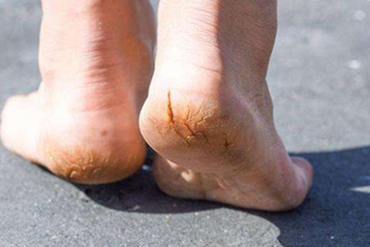 皮肤皲裂脚后跟皮肤粗糙图