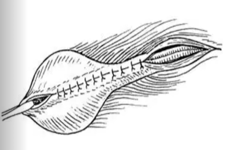 睾丸鞘膜翻转术缝合图