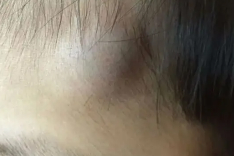 宝宝额头骨折血肿图