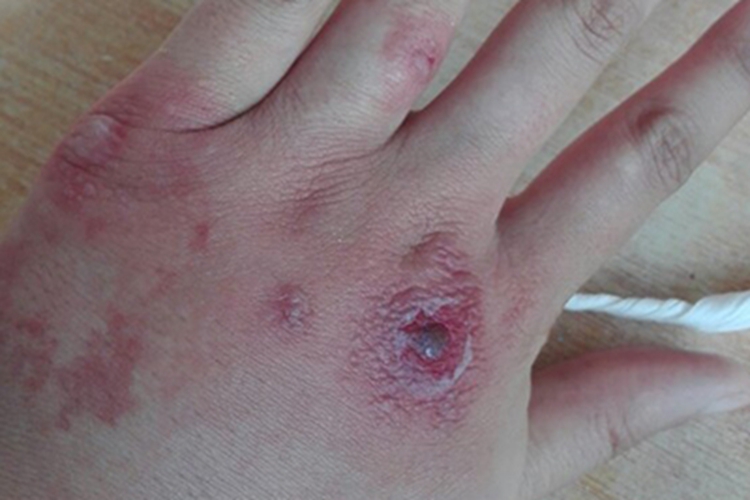 冻疮手背症状图