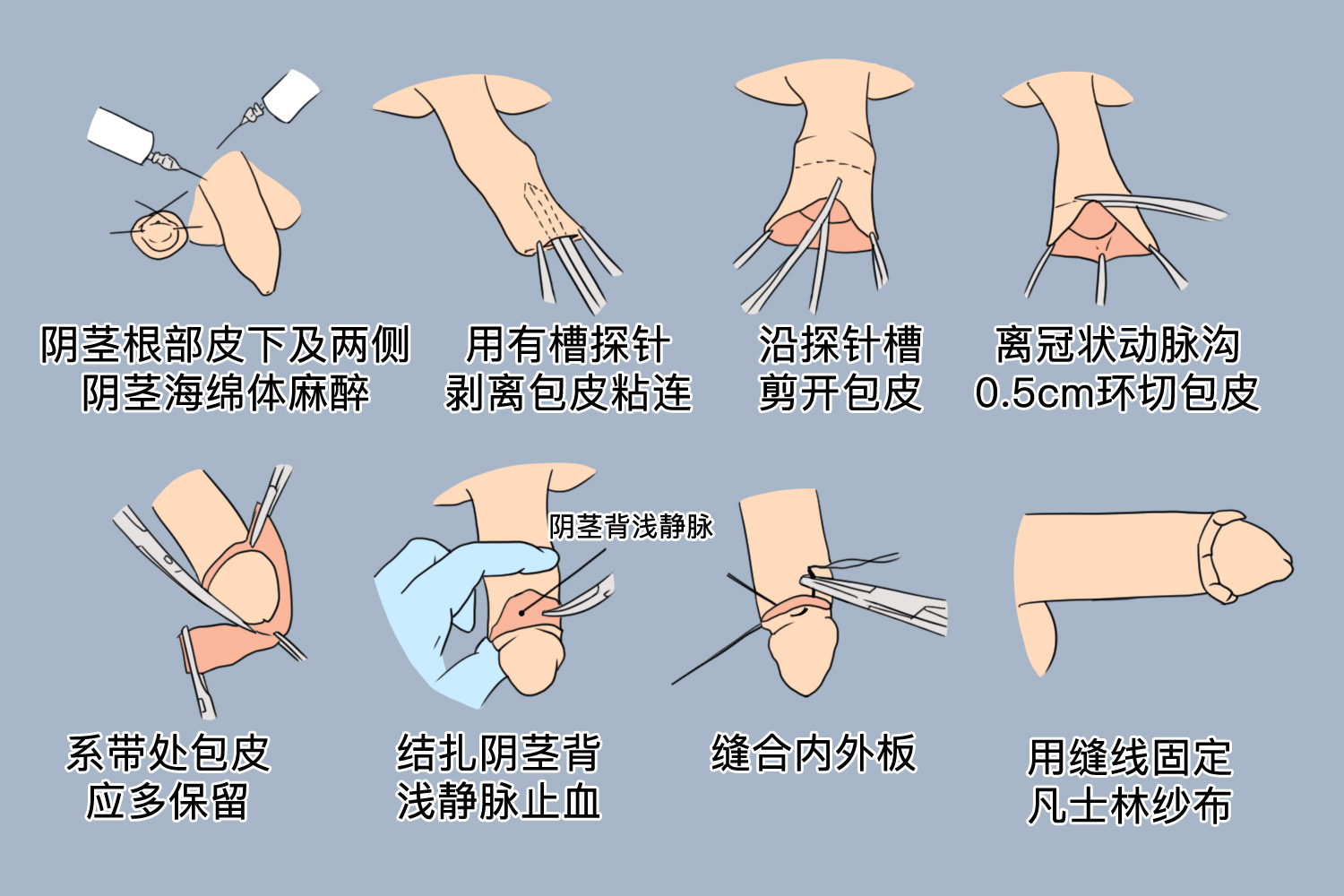 包皮环切术步骤图