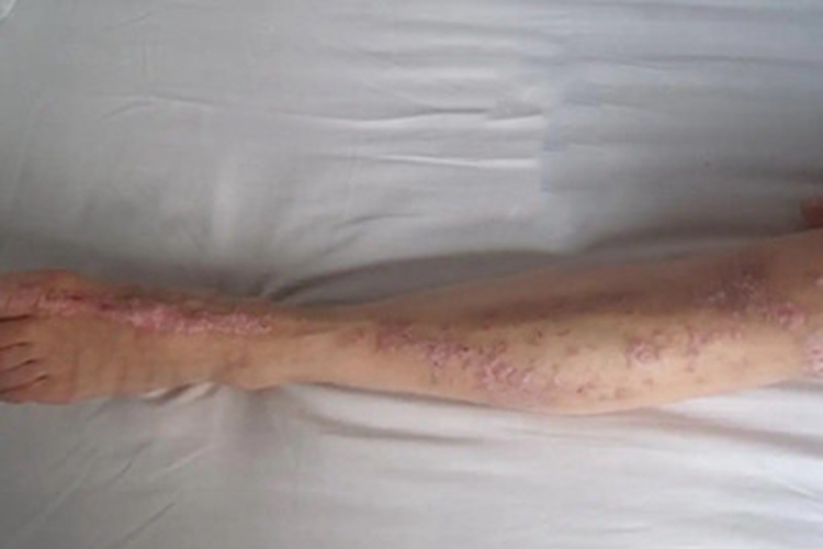 汗孔角化病小腿丘疹图