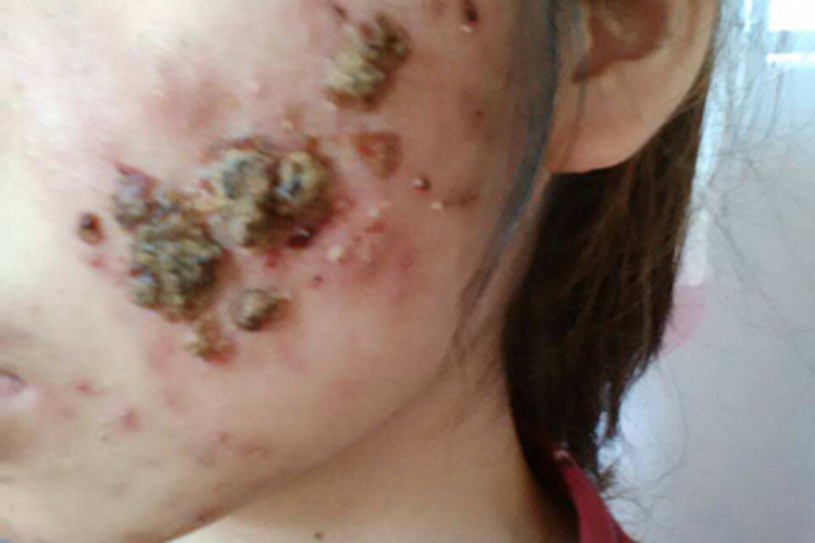 聚合性痤疮面部有大块结痂图 聚合性痤疮面部有大块结痂图