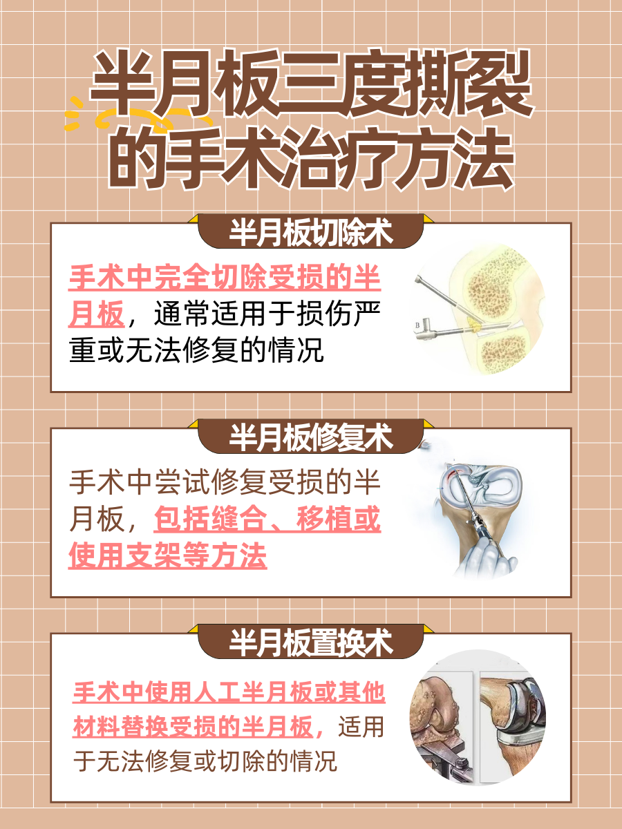 半月板三度撕裂：了解一年保守治疗是否有用