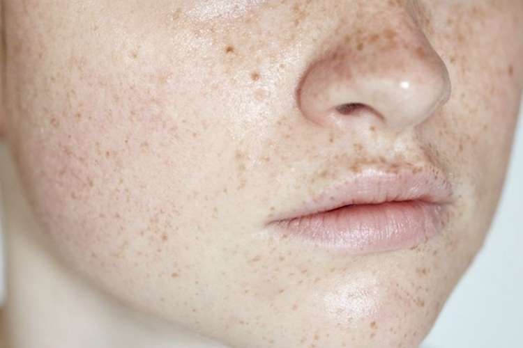 面部雀斑图 面部雀斑图