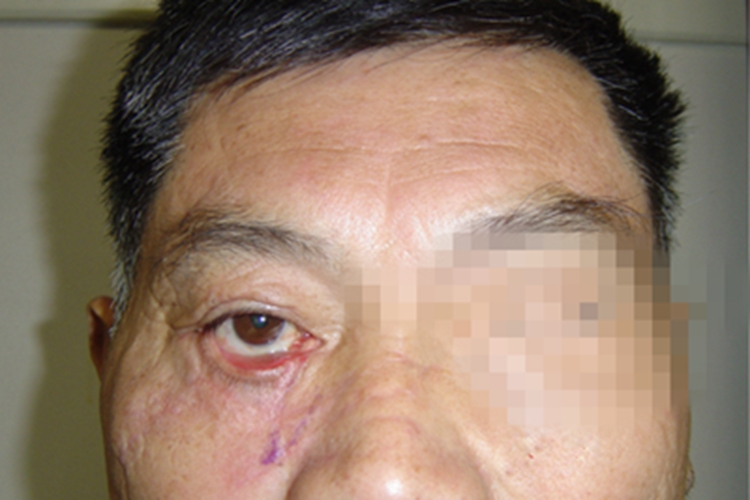 下睑外翻变形图