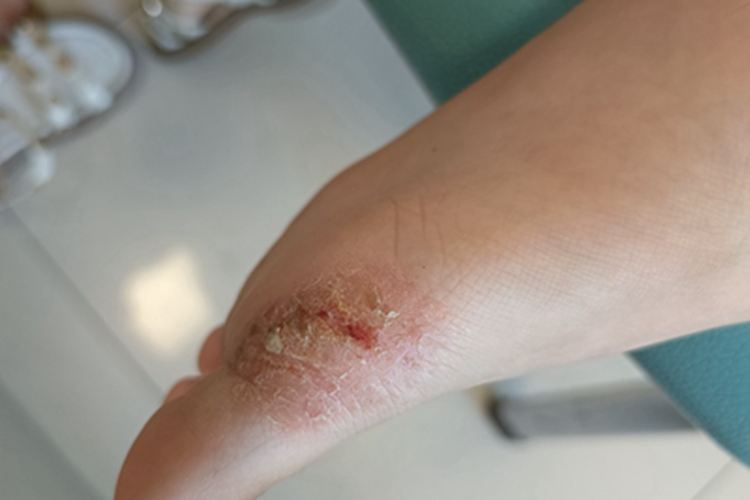 糜烂型足癣脚部症状图 糜烂型足癣脚部症状图