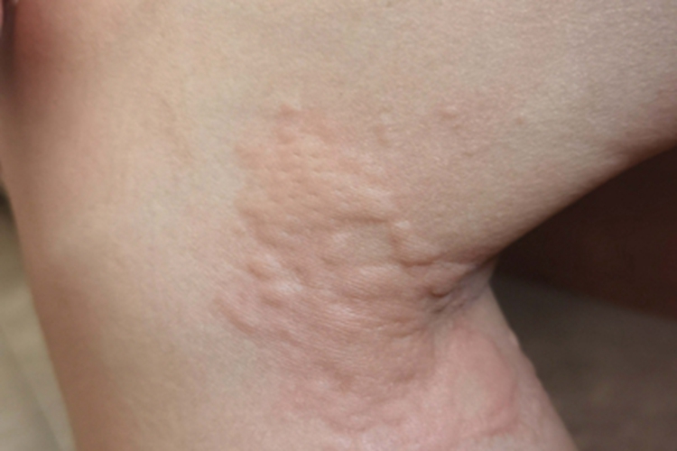 急性自发性荨麻疹腘窝疙瘩图