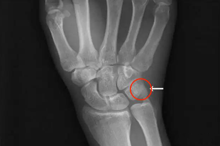 手腕豆状骨影像图