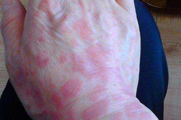 寻常狼疮手背聚集性红斑图 寻常狼疮手背聚集性红斑图