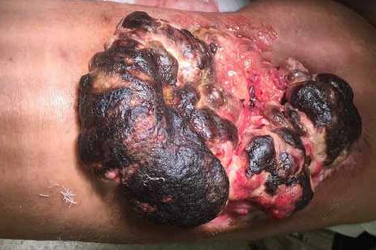 皮下脂肪瘤恶变图