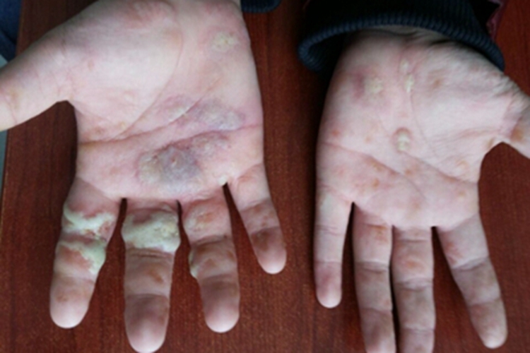 疱疹样脓疱病手掌脓包图 疱疹样脓疱病手掌脓包图