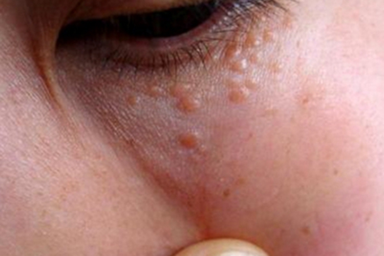汗腺瘤下眼睑扁平红疙瘩图