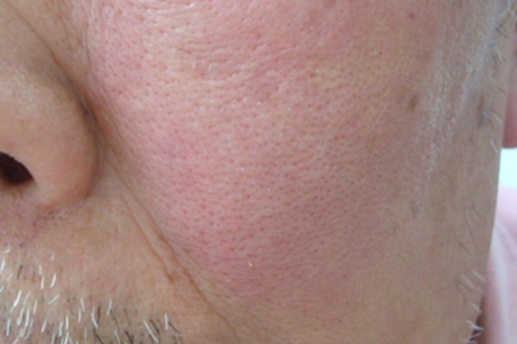 丹毒症状图 丹毒症状图