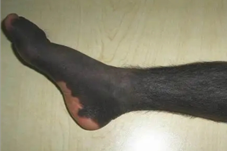 兽皮痣小腿症状图