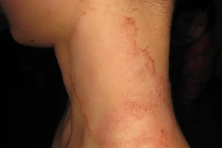 远心性环状红斑颈部症状图