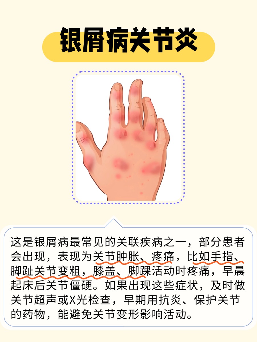 银屑病会引起哪些疾病？医生：不控制后果重