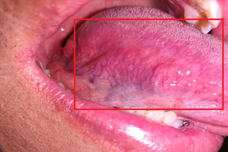 叶状乳头炎图 叶状乳头炎图