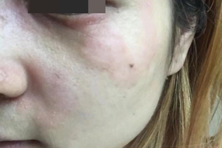 神经性皮炎面部症状图