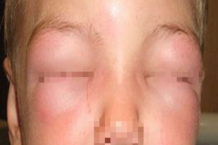 旋毛虫病眼睑水肿图