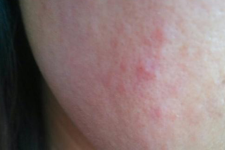 酒精过敏轻度红疹图
