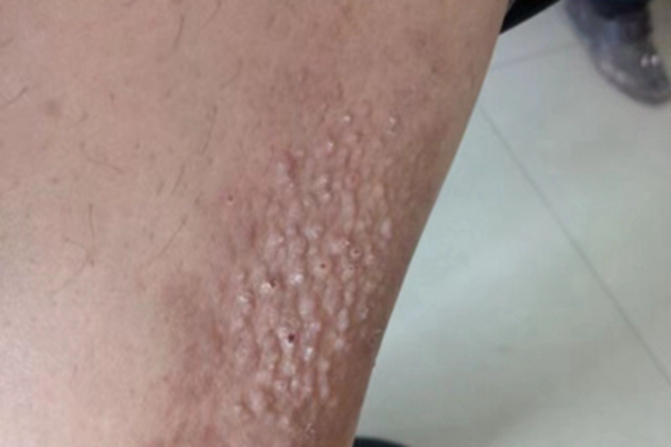 慢性湿疹大腿丘疹图 慢性湿疹大腿丘疹图