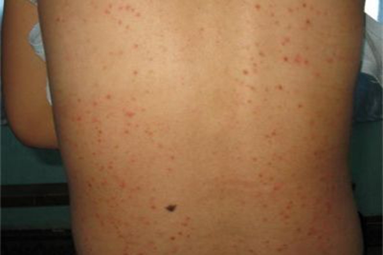 毛发红糠疹性红皮病背部症状图