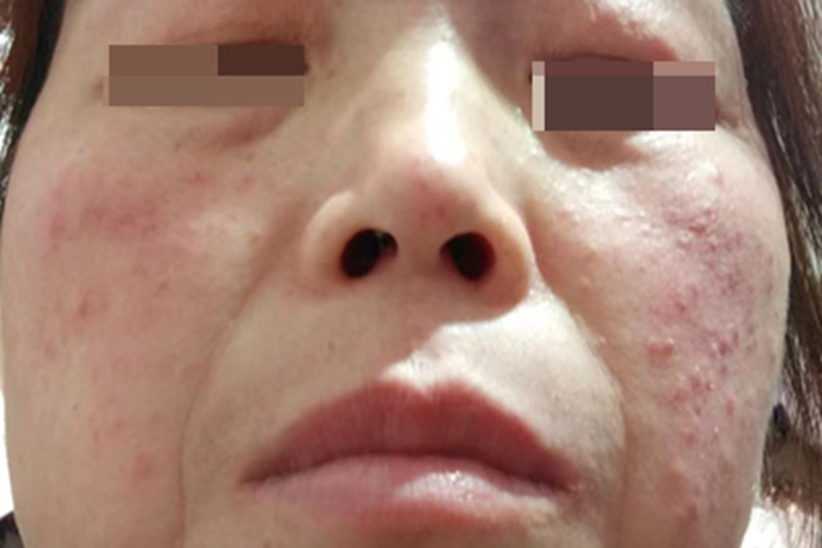 糖皮质激素依赖性皮炎脸红疙瘩图