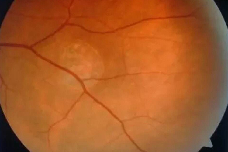 渗出性视网膜脱离图