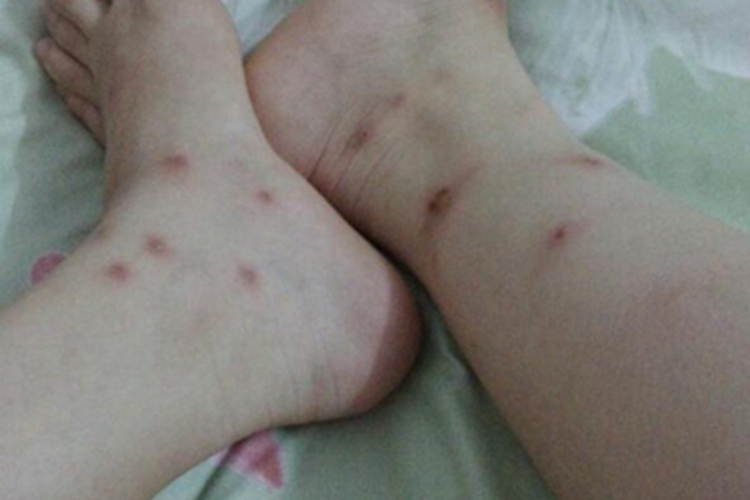 体虱病脚踝血痂图