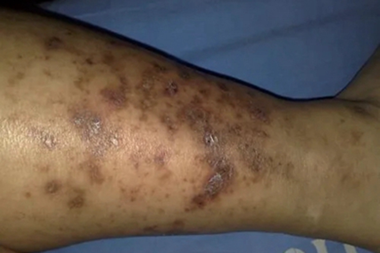 变应性皮肤血管炎色素沉着图