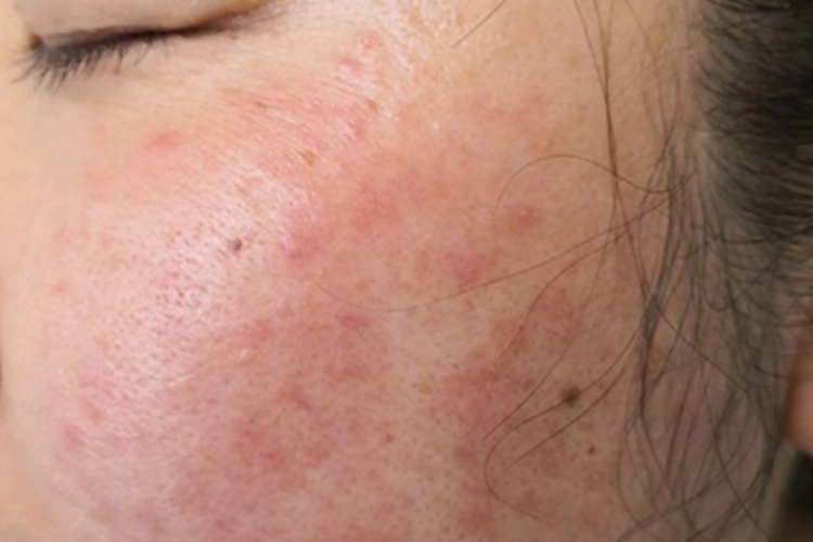 光接触性皮炎红点图