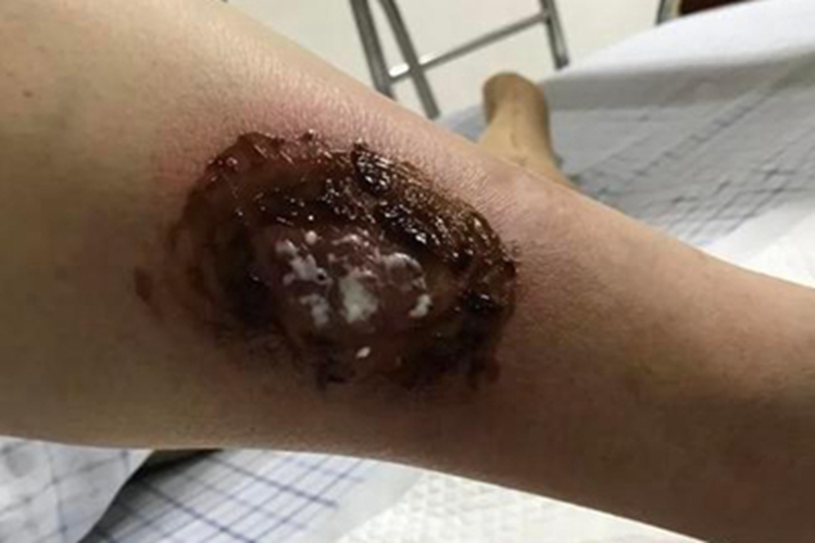 急性网状淋巴管炎小腿坏死溃疡图