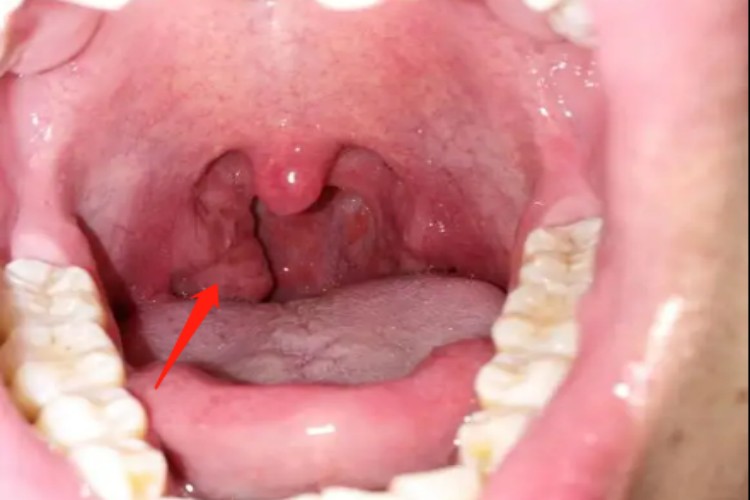 淋菌性咽炎扁桃体肿大图